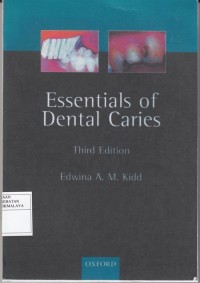 Image of Essential Of Dental Caries