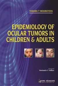 Image of Epidemiology of Ocular Tumors in Childern and Adults