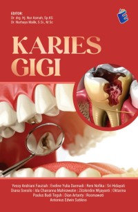 Image of Karies Gigi